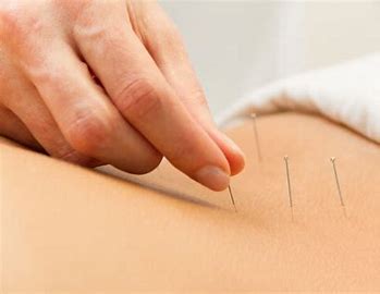 Acupuncture Price in 2025: Session Costs, Factors & Savings Tips