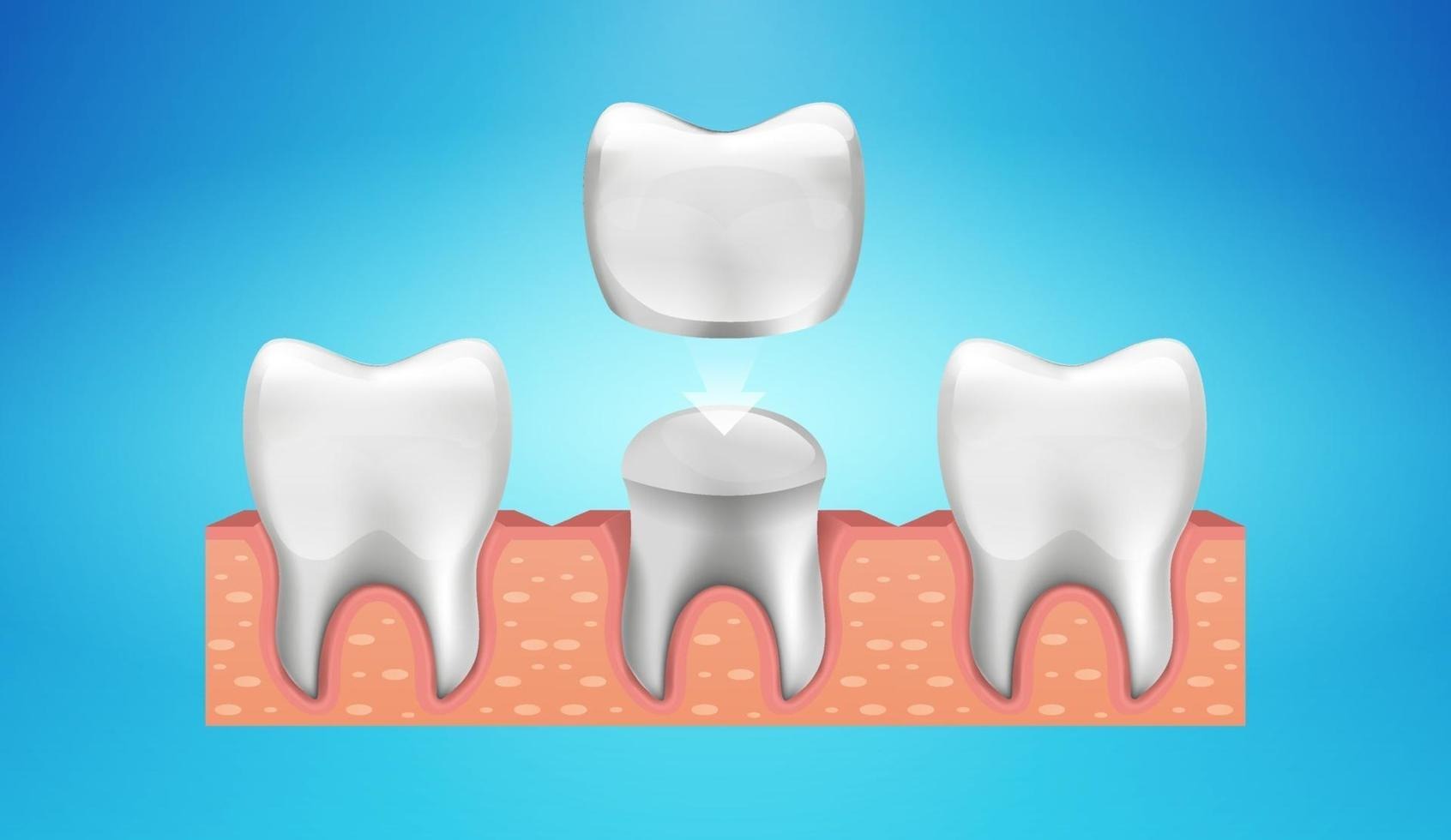 Front Teeth Crowns: Ultimate Guide to Dental Caps and Oral Health