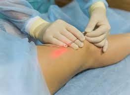 Laser Treatment for Varicose Veins: Safe, Effective & Minimally Invasive Solution