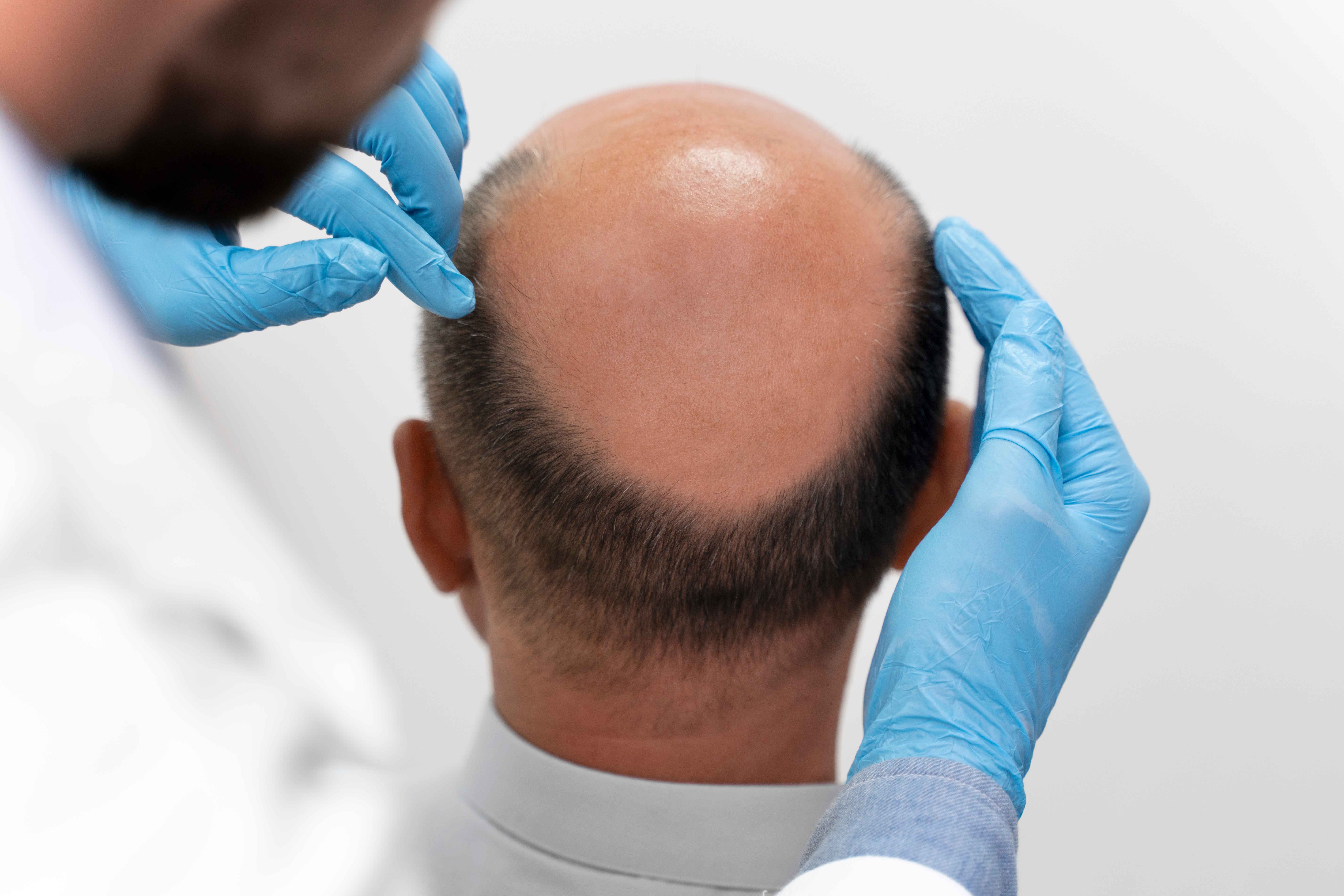 Discover the Life-Changing Benefits of Hair Transplant in Pune